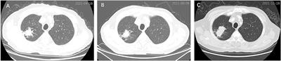 Gastric Metastasis of Primary Lung Cancer: Case Report and Systematic Review With Pooled Analysis
